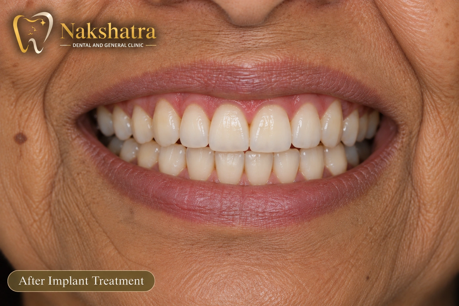 After dental smile transformation, case 2